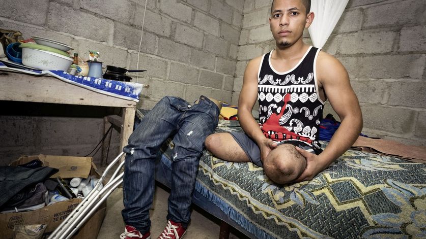 Der beidbeinig amputierte Miguel Elcides (21 Jahre) traegt zwei Oberschenkelprothesen. Vor drei Jahren versuchte Miguel, wie viele der hondurianischen Armutsfluechtlinge, auf dem Dach eines Gueterzuges ueber Mexiko die Vereinigten Staaten zu erreichen. Er geriet zwischen die Waggons des Gueterzuges und verlor beide Beine. Miguel zeigt seine Amputationsstuempfe.
