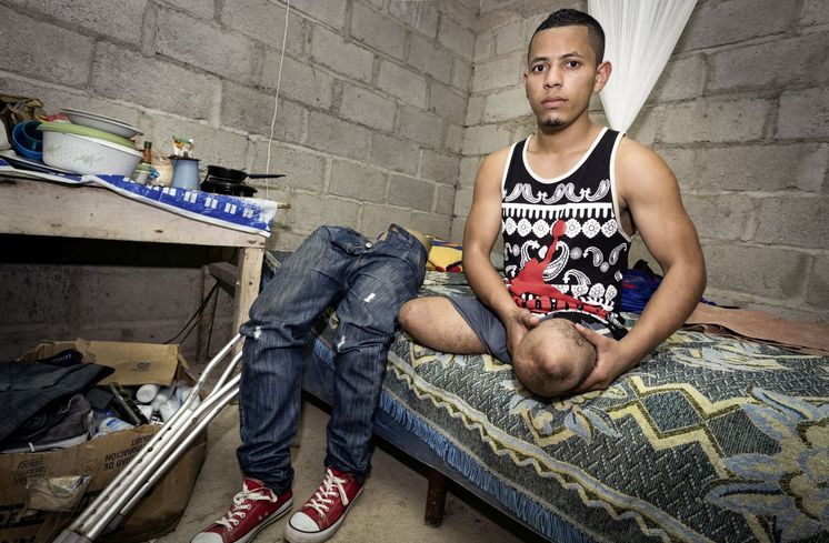 Der beidbeinig amputierte Miguel Elcides (21 Jahre) traegt zwei Oberschenkelprothesen. Vor drei Jahren versuchte Miguel, wie viele der hondurianischen Armutsfluechtlinge, auf dem Dach eines Gueterzuges ueber Mexiko die Vereinigten Staaten zu erreichen. Er geriet zwischen die Waggons des Gueterzuges und verlor beide Beine. Miguel zeigt seine Amputationsstuempfe.