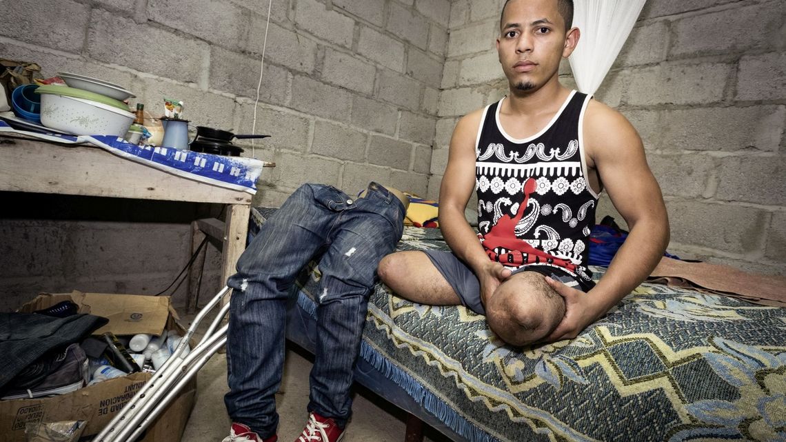 Der beidbeinig amputierte Miguel Elcides (21 Jahre) traegt zwei Oberschenkelprothesen. Vor drei Jahren versuchte Miguel, wie viele der hondurianischen Armutsfluechtlinge, auf dem Dach eines Gueterzuges ueber Mexiko die Vereinigten Staaten zu erreichen. Er geriet zwischen die Waggons des Gueterzuges und verlor beide Beine. Miguel zeigt seine Amputationsstuempfe.